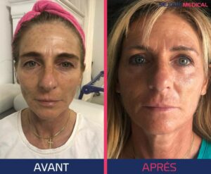 blepharoplastie avec lipofilling visage 1 1024x843