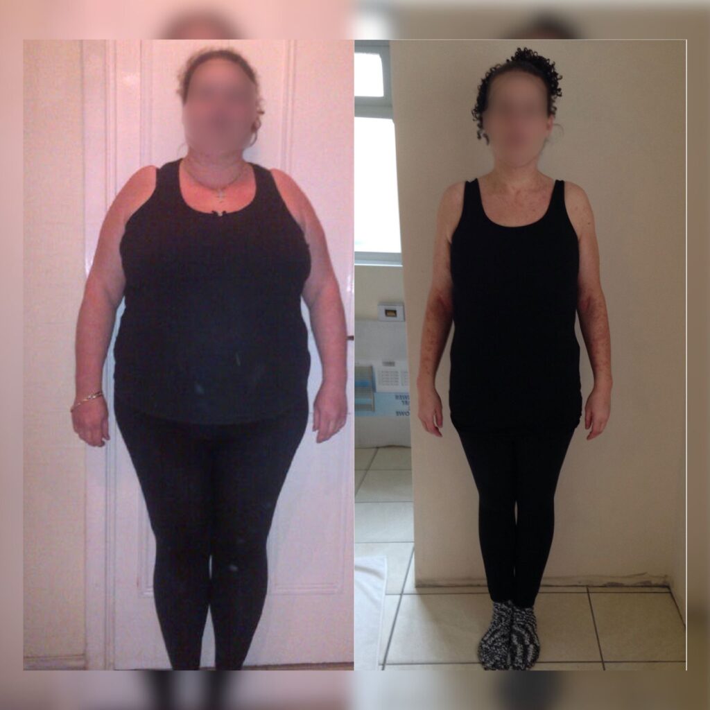 gastric bypass before and after photo by dr. vasilikostas in london uk 3 1024x1024