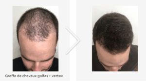 greffe de cheveux golfes + vertex
