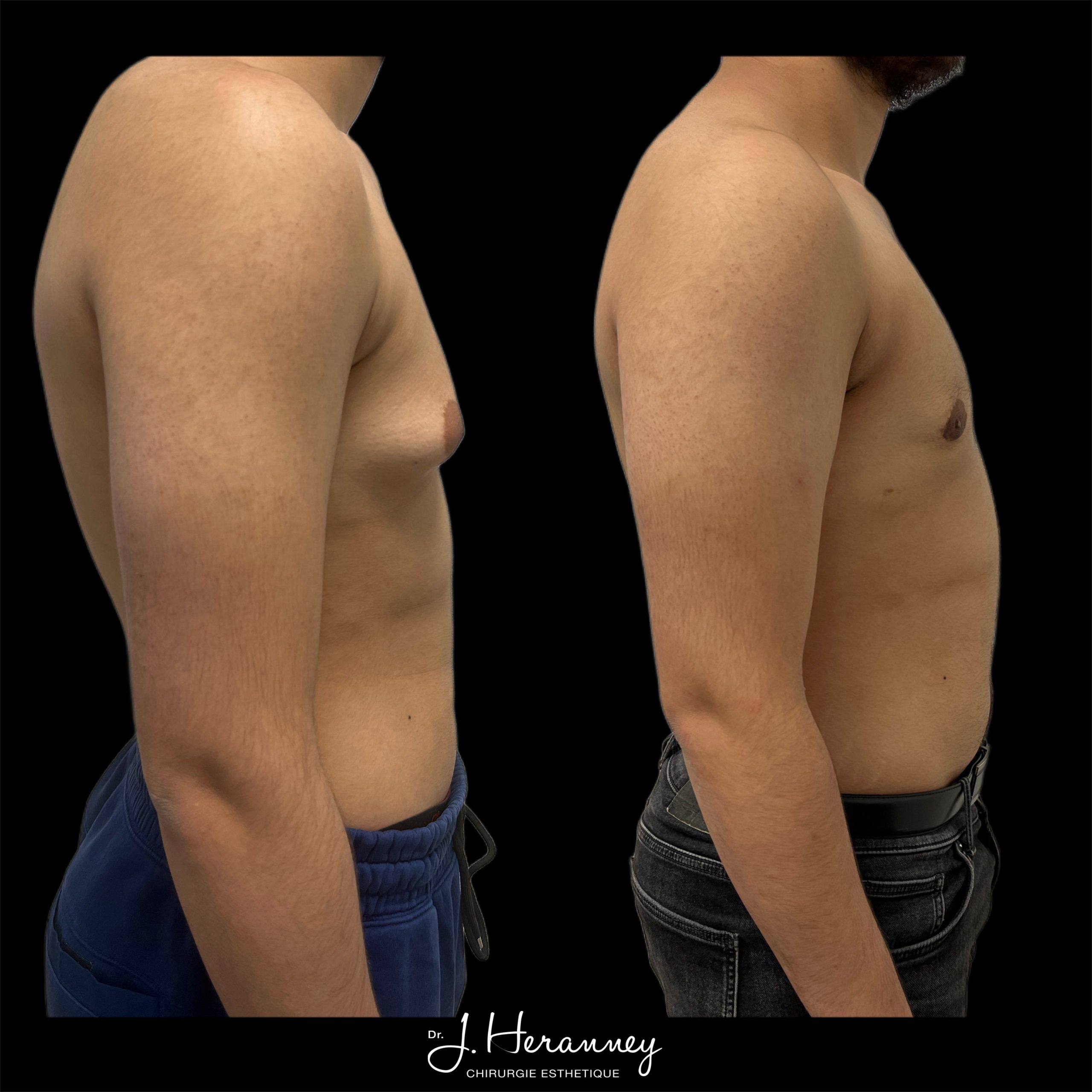 photo gynecomastie 5 scaled