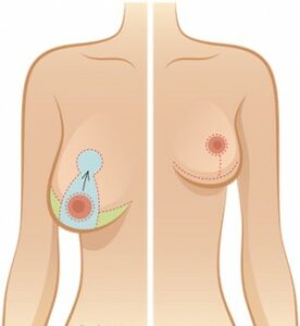 lifting seins en tunis e1550505286765