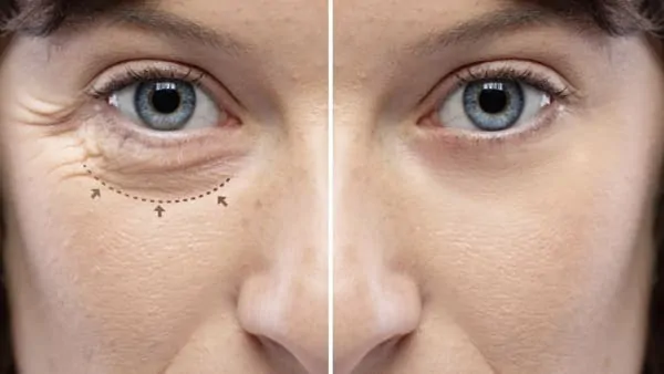 cicatrices apres blepharoplastie dr alexandre bouhanna chirurgien esthetique paris est vincennes