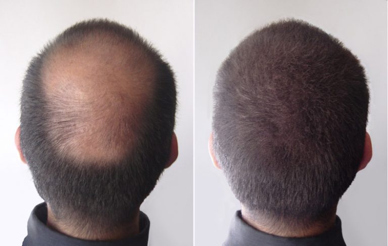 greffe cheveux avant après 768x488 1