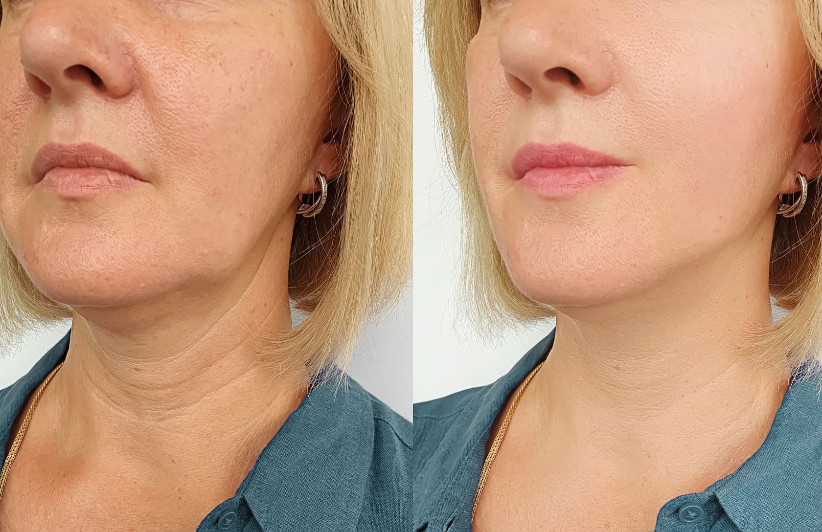 operation fils tenseurs dr petit